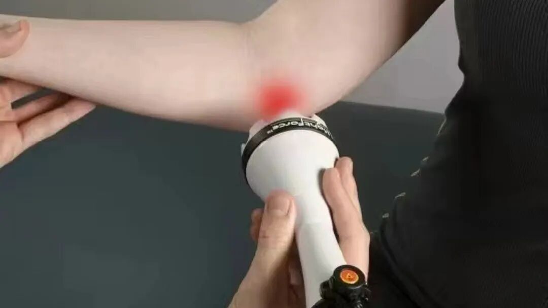 骨科理疗是什么骨科康复理疗新理念——冲击“波”与高能量激“光”的联合应用_https://www.jmylbn.com_新闻资讯_第3张