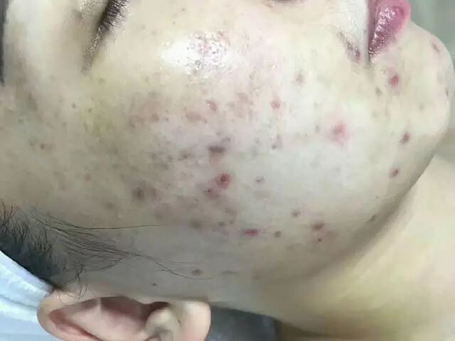 你应该知道的痘痘疯长的原因