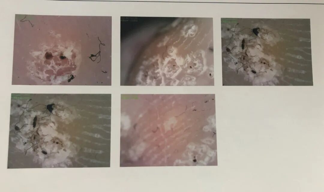 医用皮肤镜什么牌子好平原县第一人民医院皮肤科新引进皮肤镜“神器”，到底有多神奇？_https://www.jmylbn.com_新闻资讯_第4张