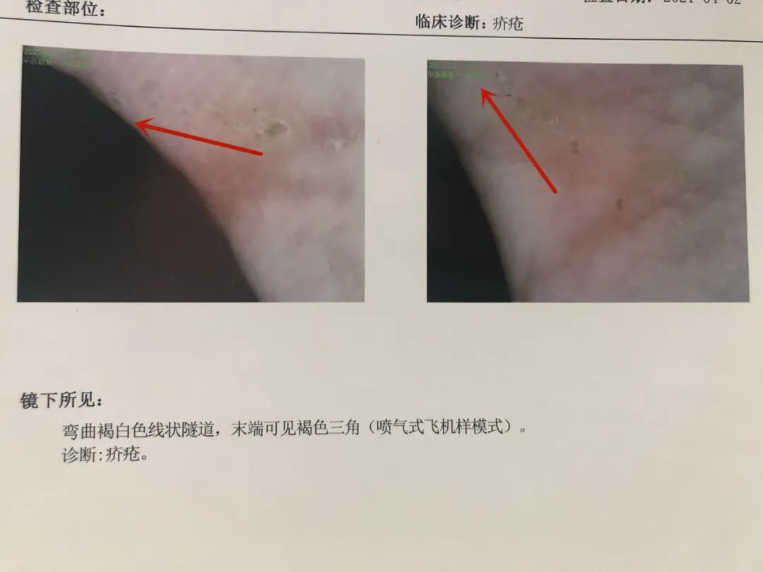 医用皮肤镜什么牌子好平原县第一人民医院皮肤科新引进皮肤镜“神器”，到底有多神奇？_https://www.jmylbn.com_新闻资讯_第5张