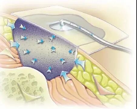 为什么负压引流负压吸引与湿性愈合，创面修复有惊喜_https://www.jmylbn.com_新闻资讯_第3张