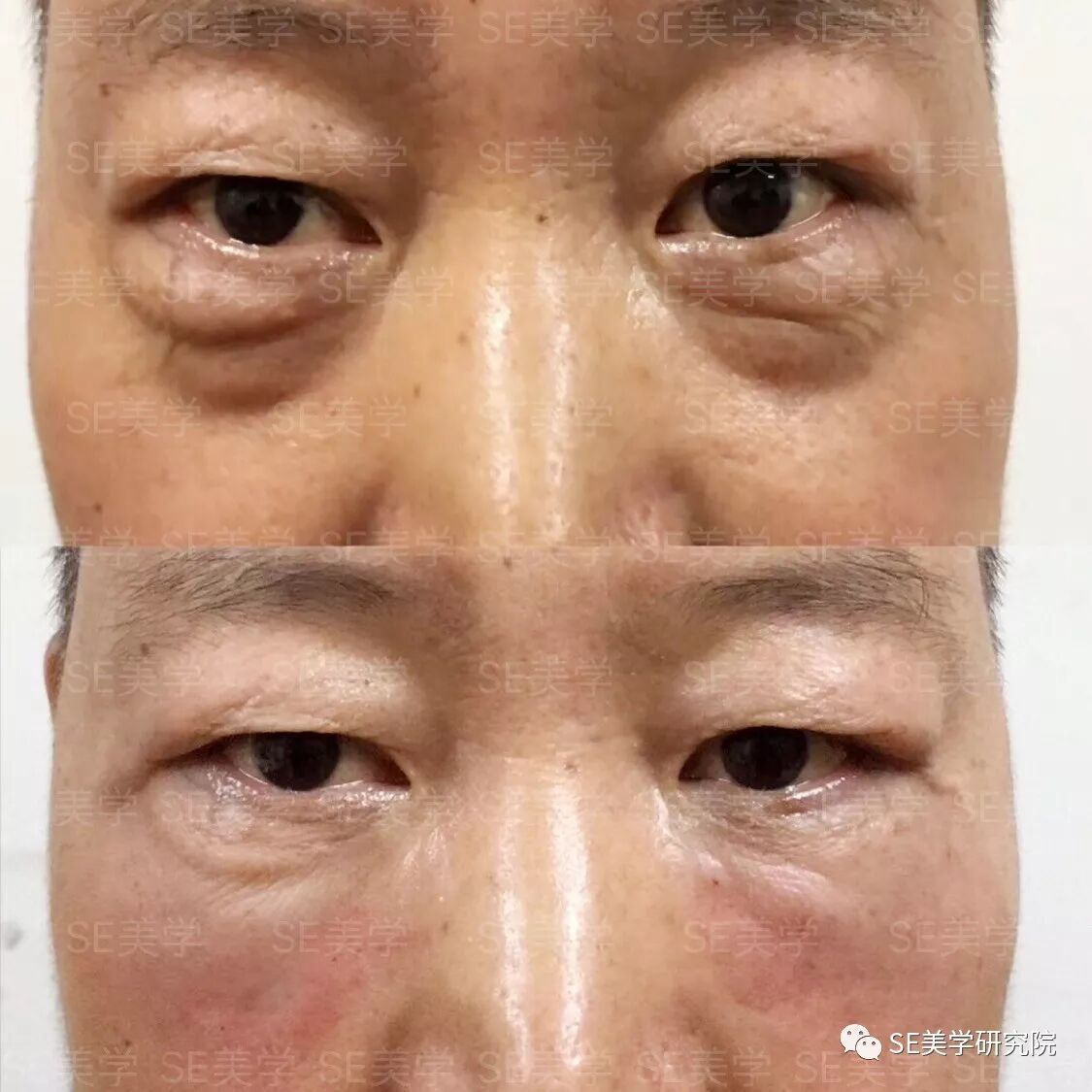 再也不用玻尿酸填充,再也不用肉毒素去皱,再也不用开刀做眼袋-还你