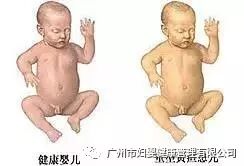 为什么要用光疗纸尿裤新品丨专为避蓝光设计的新生儿避蓝光护阴纸尿裤，婴儿光疗防护眼罩​_https://www.jmylbn.com_新闻资讯_第3张