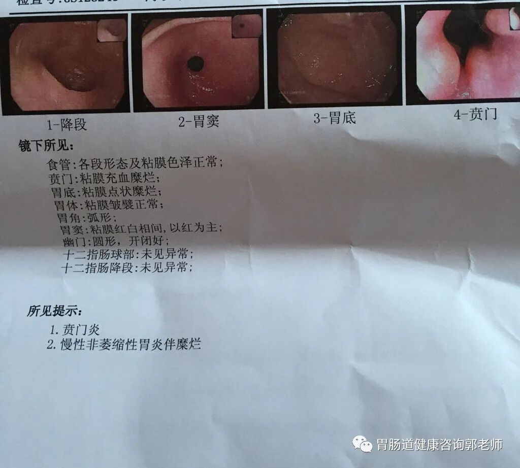 慢性非萎缩性胃炎到底是怎么回事