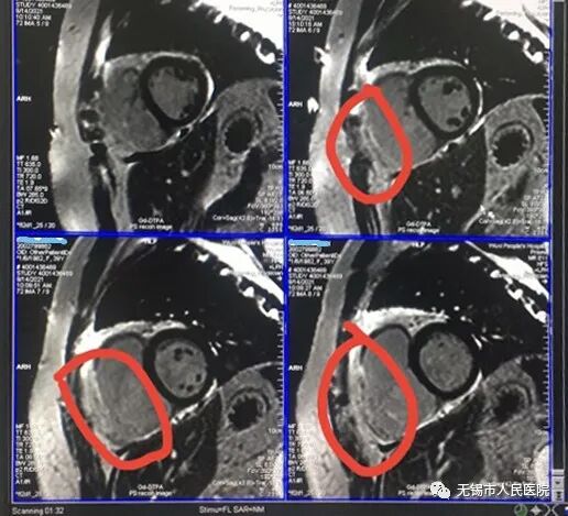 手动心电图怎么拉【仁医妙手】拉肚子就诊却被查出罕见心脏病——人医心电图医生慧眼识图_https://www.jmylbn.com_新闻资讯_第5张