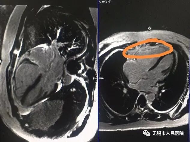 手动心电图怎么拉【仁医妙手】拉肚子就诊却被查出罕见心脏病——人医心电图医生慧眼识图_https://www.jmylbn.com_新闻资讯_第6张