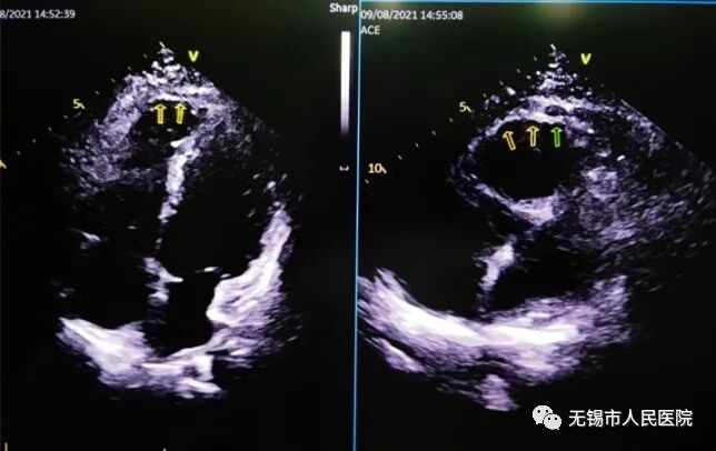 手动心电图怎么拉【仁医妙手】拉肚子就诊却被查出罕见心脏病——人医心电图医生慧眼识图_https://www.jmylbn.com_新闻资讯_第4张
