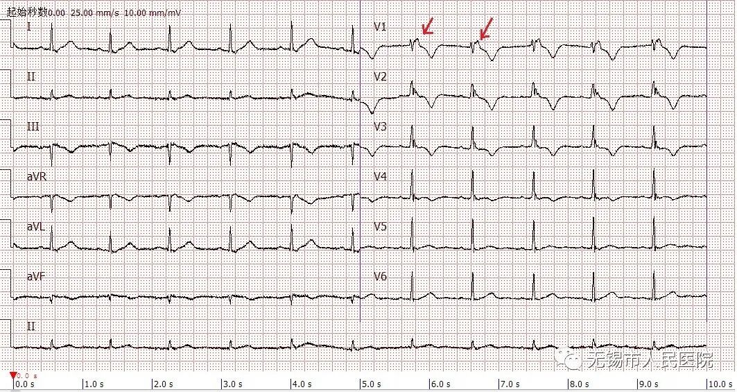 手动心电图怎么拉【仁医妙手】拉肚子就诊却被查出罕见心脏病——人医心电图医生慧眼识图_https://www.jmylbn.com_新闻资讯_第3张