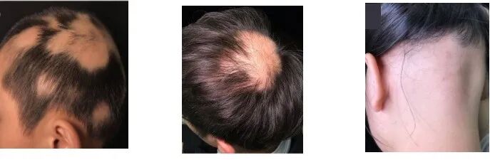 得了鬼剃头（斑秃）咋办？