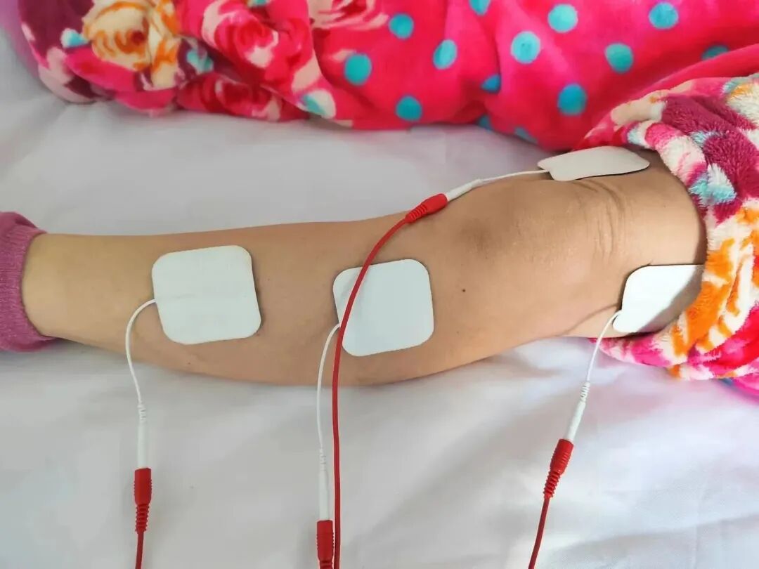 怎么买神经肌肉康复仪让肌肉“舞动”起来  肌体功能好起来——神经肌肉电刺激仪_https://www.jmylbn.com_新闻资讯_第4张