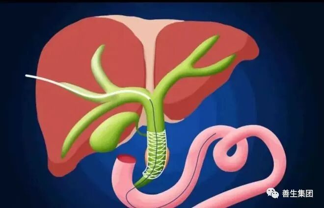 胆管支架什么样子经皮肝胆管穿刺置管引流术（PTCD）及胆道内支架临床应用_https://www.jmylbn.com_新闻资讯_第2张