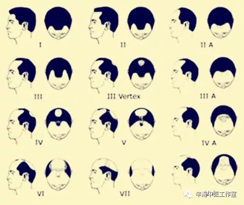 脱发离你我很远么？脱发的原因有哪些？（下期讲脱发怎么办？）