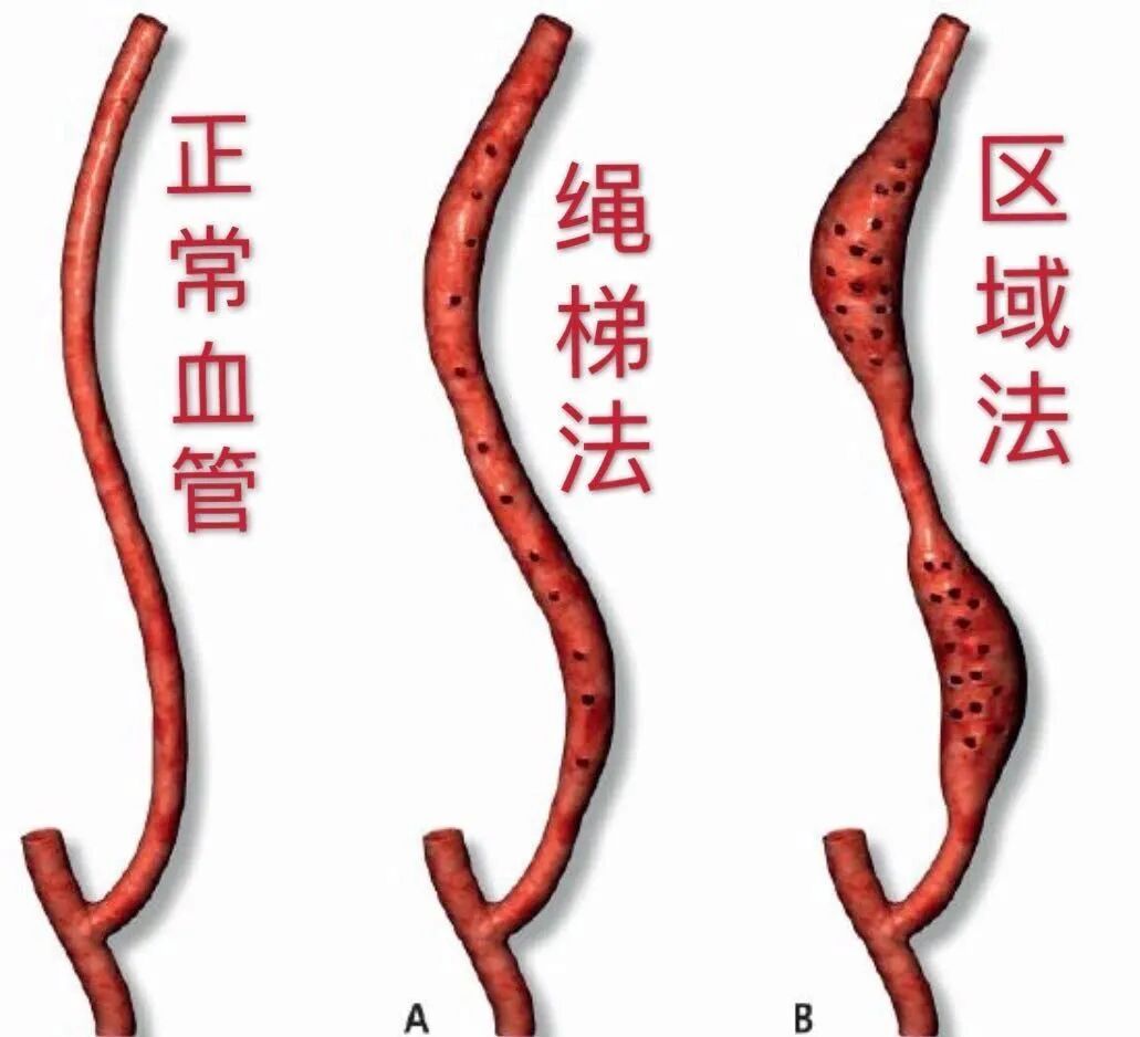 穿刺针怎么用【图说穿刺】用什么针 走什么位 ｜ 你的透析通道“命由针定”_https://www.jmylbn.com_新闻资讯_第5张