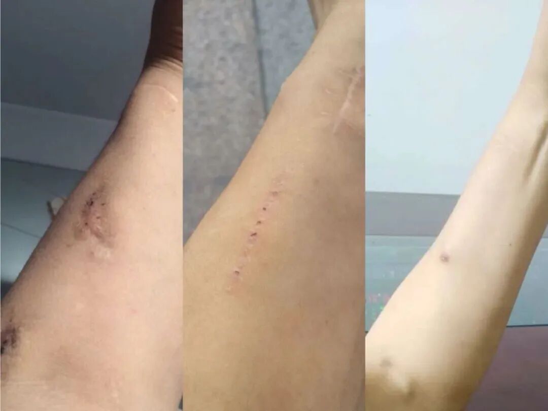 穿刺针怎么用【图说穿刺】用什么针 走什么位 ｜ 你的透析通道“命由针定”_https://www.jmylbn.com_新闻资讯_第6张