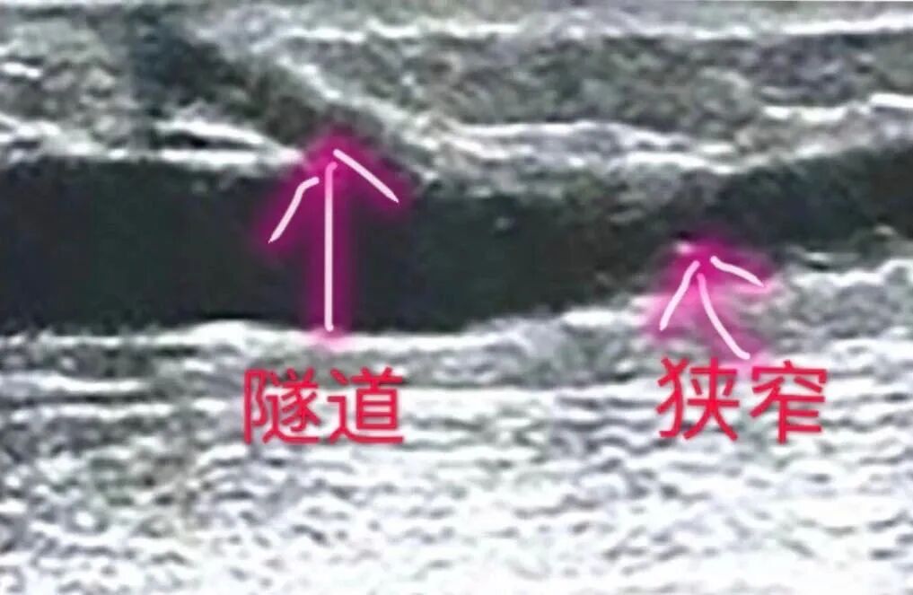 穿刺针怎么用【图说穿刺】用什么针 走什么位 ｜ 你的透析通道“命由针定”_https://www.jmylbn.com_新闻资讯_第14张