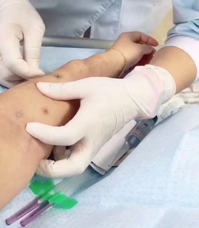 穿刺针怎么用【图说穿刺】用什么针 走什么位 ｜ 你的透析通道“命由针定”_https://www.jmylbn.com_新闻资讯_第16张