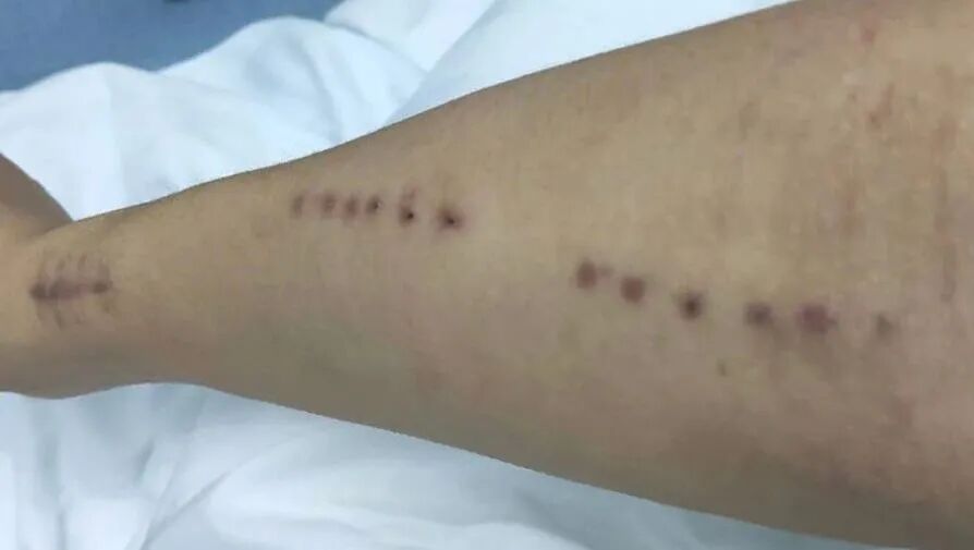 穿刺针怎么用【图说穿刺】用什么针 走什么位 ｜ 你的透析通道“命由针定”_https://www.jmylbn.com_新闻资讯_第8张