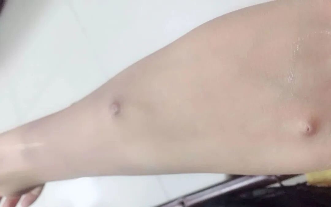 穿刺针怎么用【图说穿刺】用什么针 走什么位 ｜ 你的透析通道“命由针定”_https://www.jmylbn.com_新闻资讯_第17张