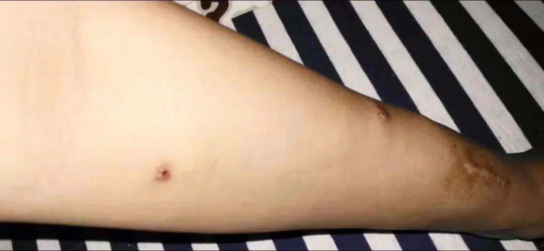 穿刺针怎么用【图说穿刺】用什么针 走什么位 ｜ 你的透析通道“命由针定”_https://www.jmylbn.com_新闻资讯_第12张