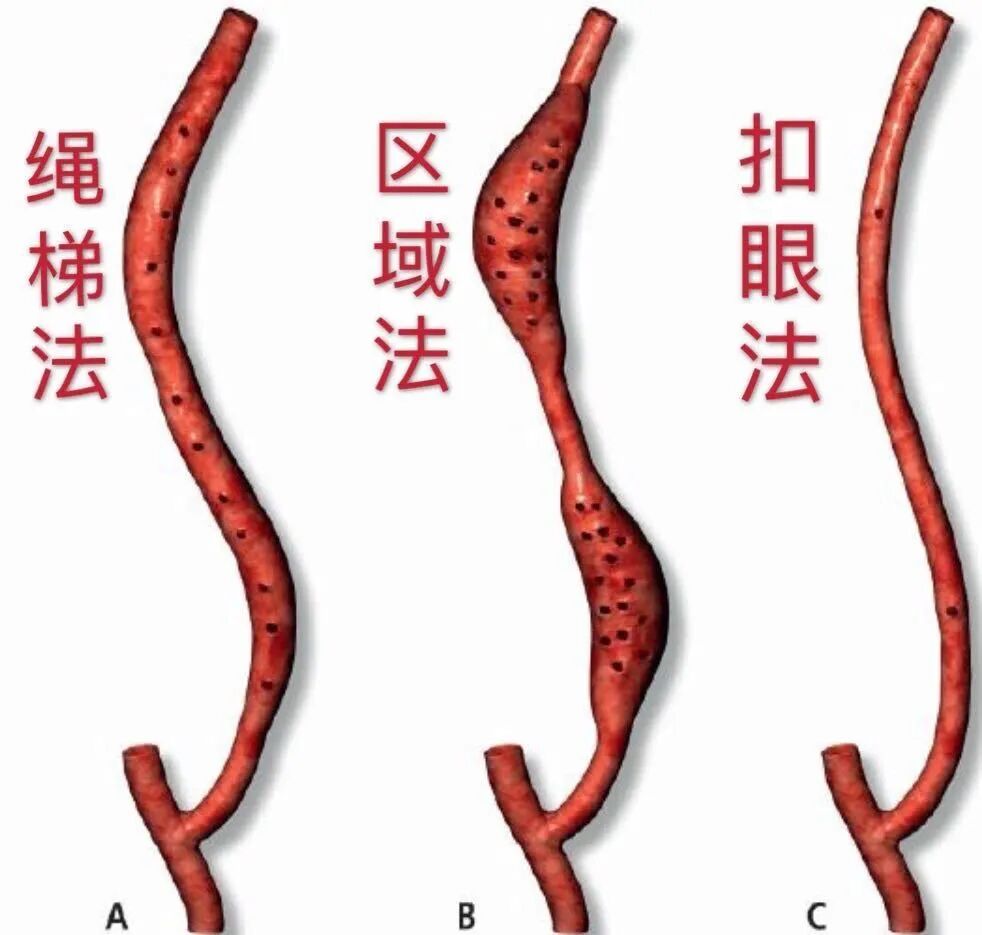 穿刺针怎么用【图说穿刺】用什么针 走什么位 ｜ 你的透析通道“命由针定”_https://www.jmylbn.com_新闻资讯_第13张