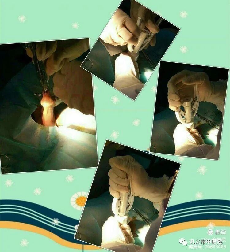 包皮吻合器是什么割包皮？“一次性包皮环切吻合器包皮环切术”了解一下_https://www.jmylbn.com_新闻资讯_第1张