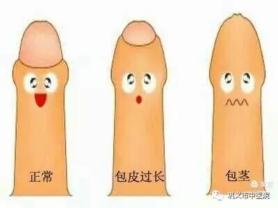 包皮吻合器是什么割包皮？“一次性包皮环切吻合器包皮环切术”了解一下_https://www.jmylbn.com_新闻资讯_第2张