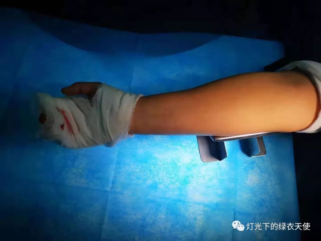 手术头皮夹怎么放（11月阅读Top1）手术缝针集合器、头皮夹清点架，手术室小发明太让人惊喜了！！_https://www.jmylbn.com_新闻资讯_第13张