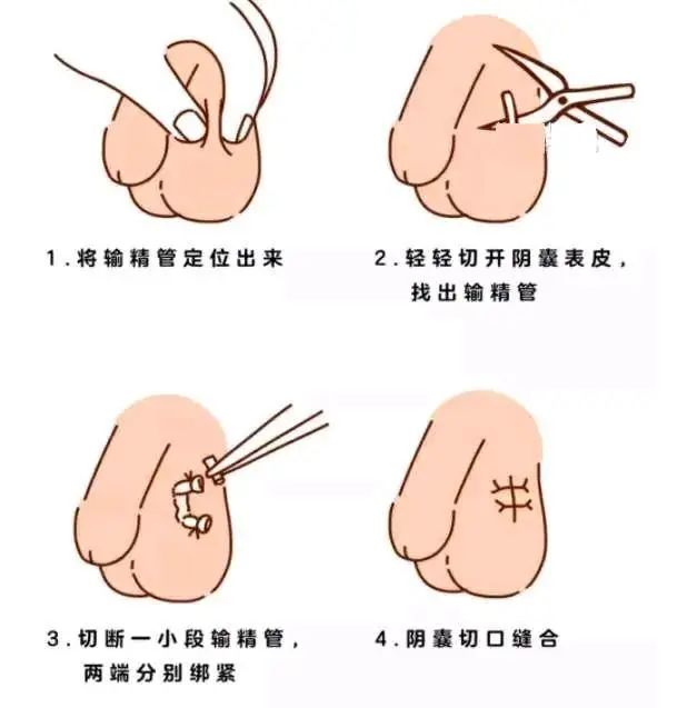 成都男性结扎手术_成都绝育手术多少钱_成都男性绝育手术