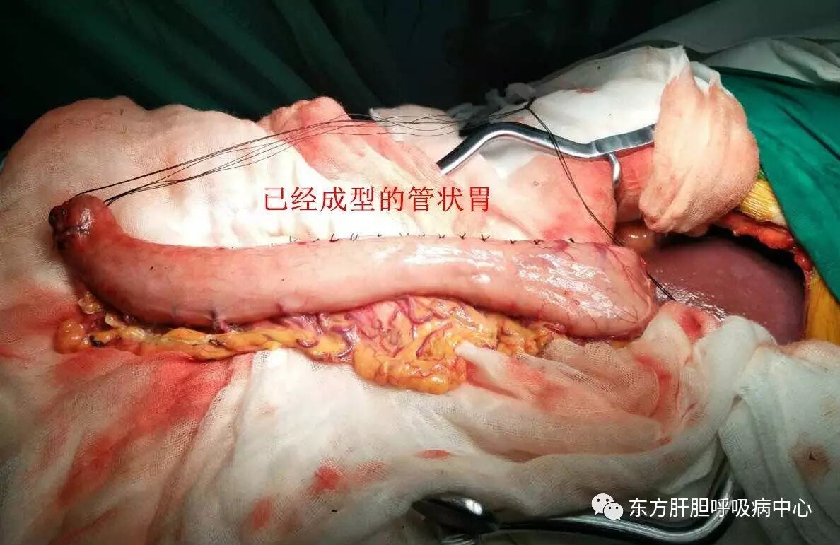 第六期【胸外科篇】食管癌专题 - 好大夫在线