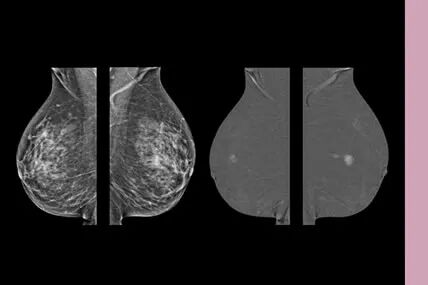 GE的超声怎么断层走进全域“医之利器”之三：GE高端数字化乳腺机_https://www.jmylbn.com_新闻资讯_第4张