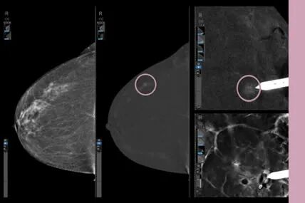 GE的超声怎么断层走进全域“医之利器”之三：GE高端数字化乳腺机_https://www.jmylbn.com_新闻资讯_第5张