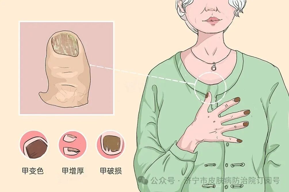 【专栏预告】关于“灰指甲”，你想知道的都在这里
