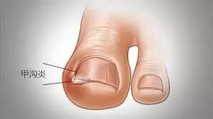 甲沟炎疗愈音乐 星际联播 微信公众号文章阅读 Wemp