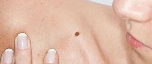 身上的痣 哪些不能留