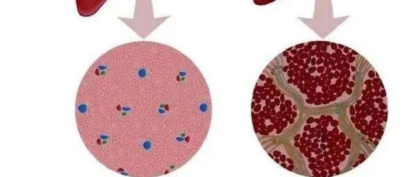 辨证施治肝硬化