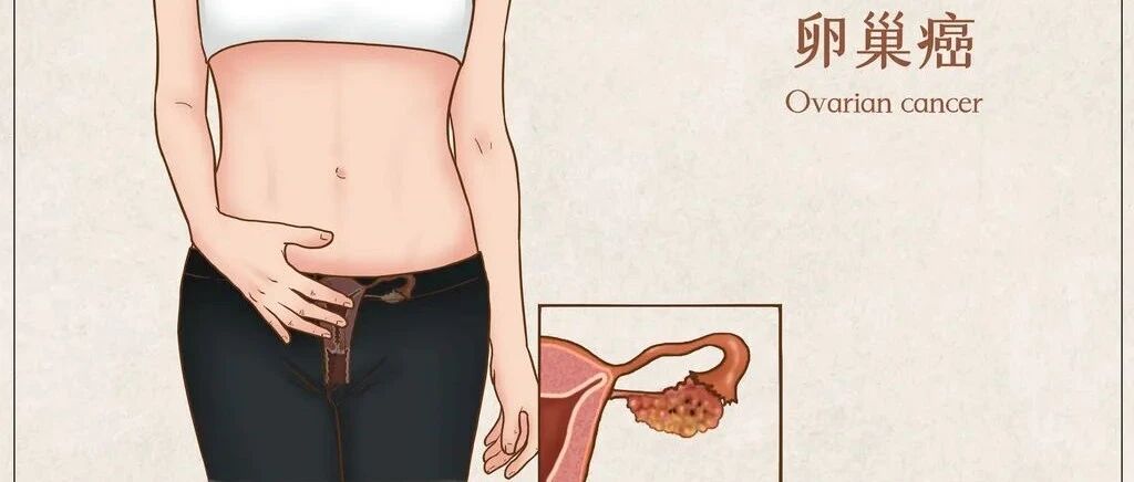 认识妇科“第一凶癌”