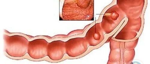 直肠癌侵犯阴道 看医生如何完成这台高难度的超低位保肛手术