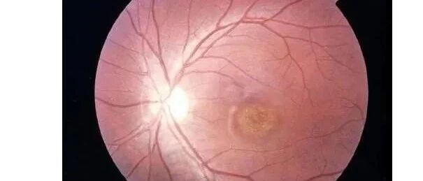 视力越来越差 毛病出在免疫系统