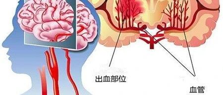 一项新研究可让脑出血患者受益