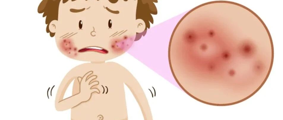 荨麻疹高发季 宝宝易中招