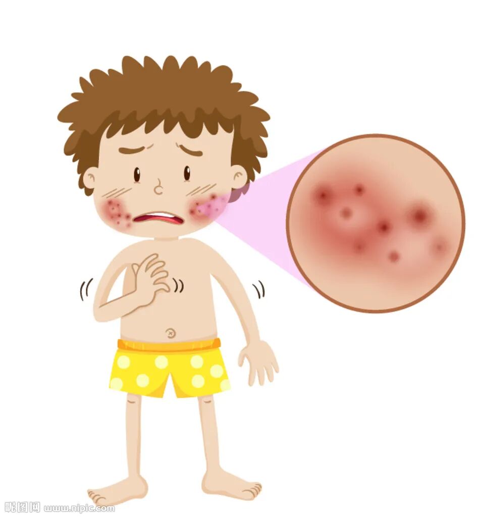 荨麻疹高发季 宝宝易中招-友友