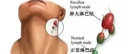 长期熬夜 淋巴癌最爱趁虚而入
