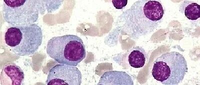 腰酸背痛 背后是这种爱伪装的肿瘤