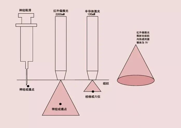偏振光治疗仪怎么样神奇的红外偏振光治疗仪，安全无创消除疼痛_https://www.jmylbn.com_新闻资讯_第4张