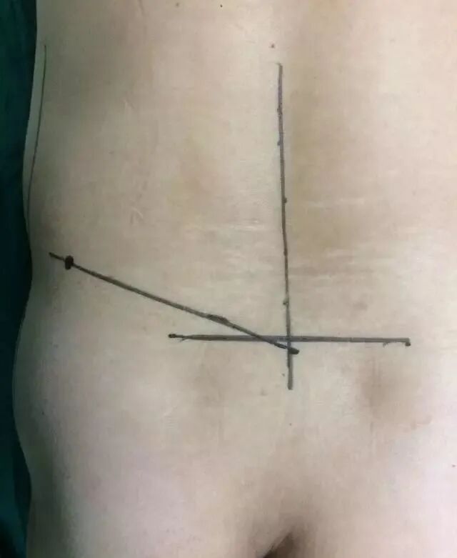 开刀孔怎么开刀椎间孔镜手术技术，不开刀解决腰腿疼痛_https://www.jmylbn.com_新闻资讯_第9张