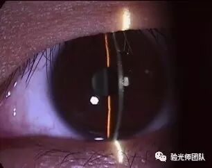 什么是裂隙灯验光检查裂隙灯检查什么？_https://www.jmylbn.com_新闻资讯_第9张