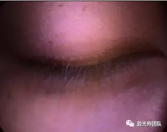 什么是裂隙灯验光检查裂隙灯检查什么？_https://www.jmylbn.com_新闻资讯_第1张