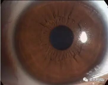 什么是裂隙灯验光检查裂隙灯检查什么？_https://www.jmylbn.com_新闻资讯_第8张