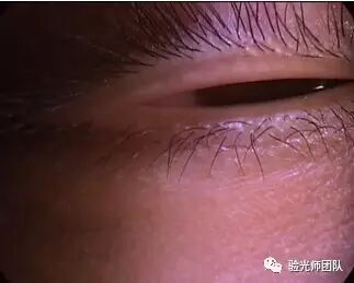 什么是裂隙灯验光检查裂隙灯检查什么？_https://www.jmylbn.com_新闻资讯_第2张