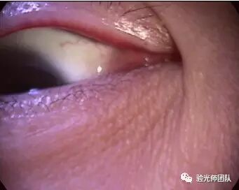 什么是裂隙灯验光检查裂隙灯检查什么？_https://www.jmylbn.com_新闻资讯_第3张